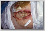 Abdominal wound